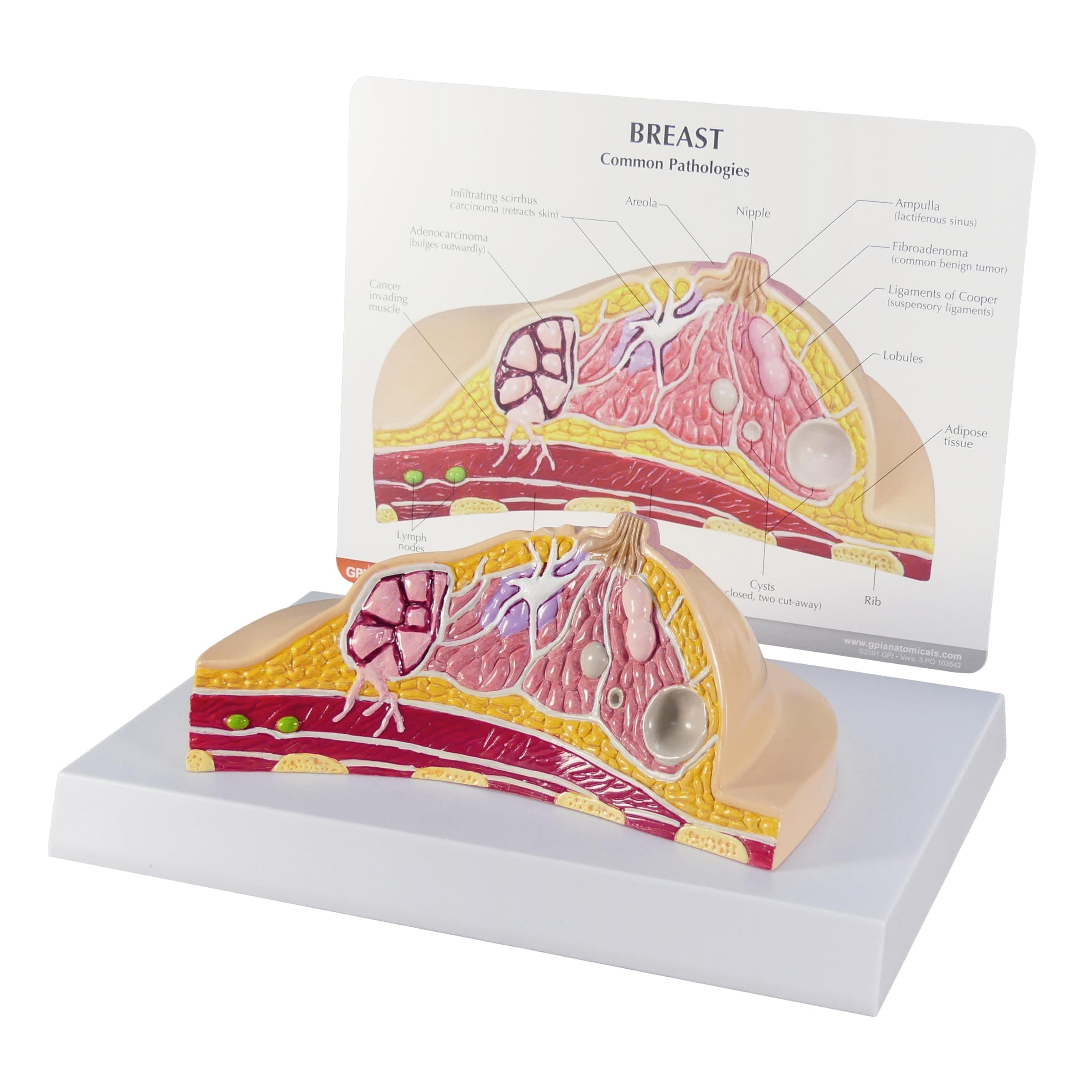 GPI Anatomicals - Breast Cross-Section Model, Replica Showing Common Pathologies for Human Anatomy, Physiology Education, Anatomy Model for Doctor's Offices and Classrooms, Medical Learning Resources